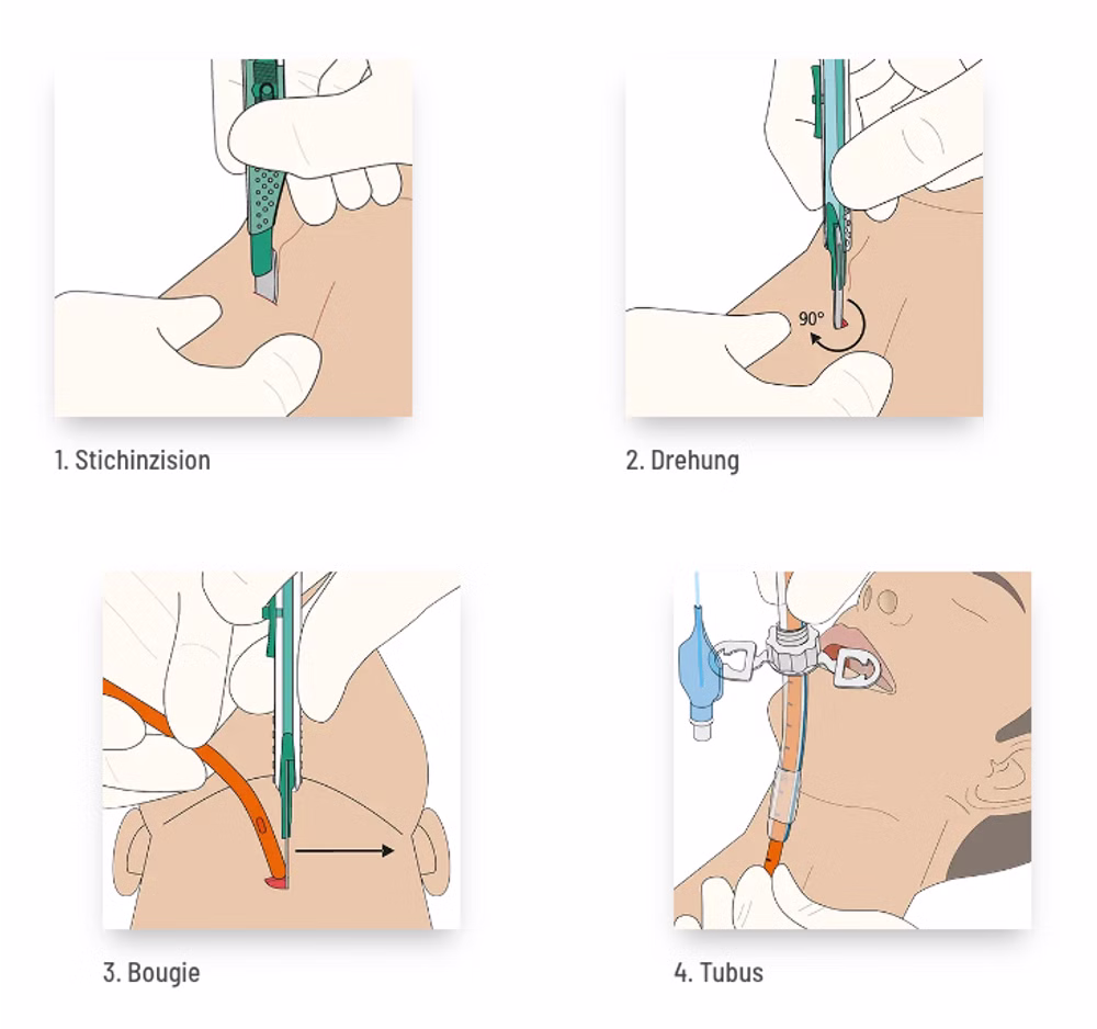 VBM ScalpelCric chirurgisches Koniotomie Set