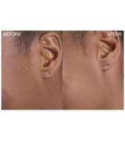 Confezione da 9 rasoi Dermaplaning Bondiblades da donna per la rimozione dei peli color pesca, rosa