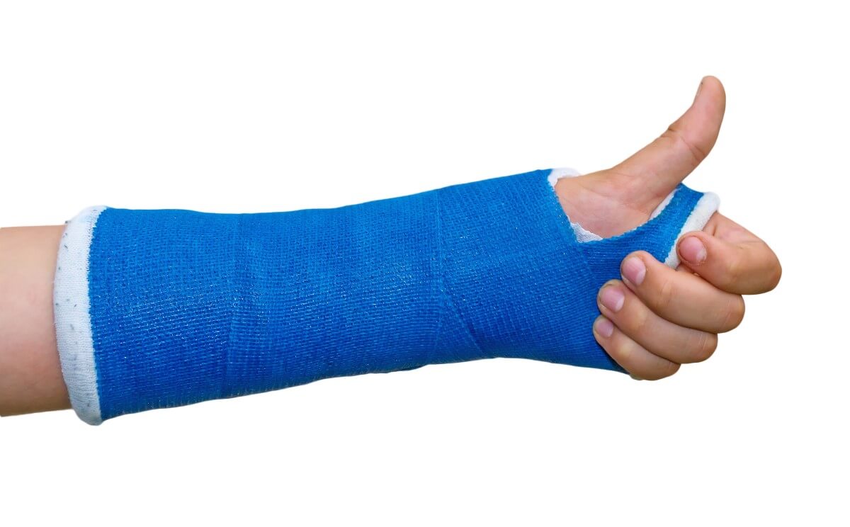 Gipsbinde am Arm Eine blaue Gipsbinde am Arm. Die Hand zeigt den Daumen hoch.