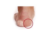 2 Schleifkopfaufsätze für EasyPedipeel, grobe Körnung
