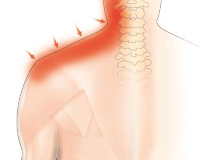 Rehband Guide des Blessures Douleur musculaire dans le cou et les epaules